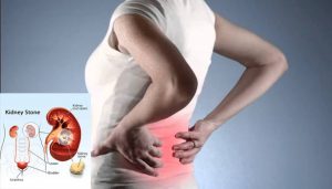 201701131023546724_Kidney-stones-in-womenCauses_SECVPF