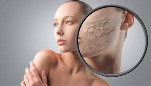 201704111337219006_summer-skin-dryness_SECVPF