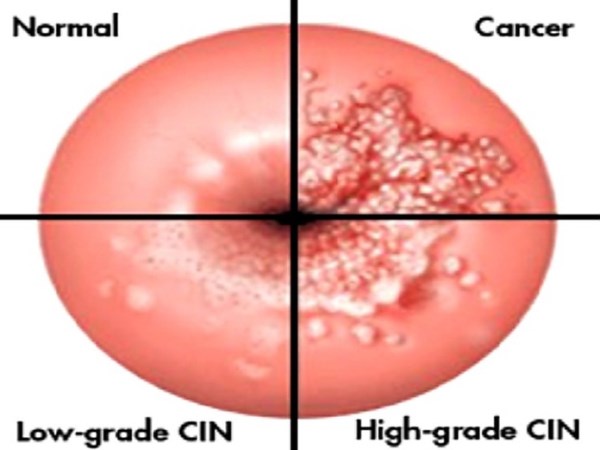 large_cervical-cancer-5789