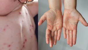 202205091146005790_Tamil_News_tomato-fever-For-Kids_SECVPF